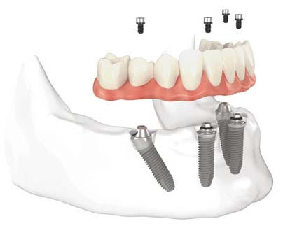 All-On-4 Plus dental implant illustration showing four implants supporting a full arch