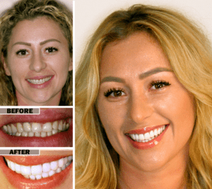 Cosmetic dentistry smile transformation