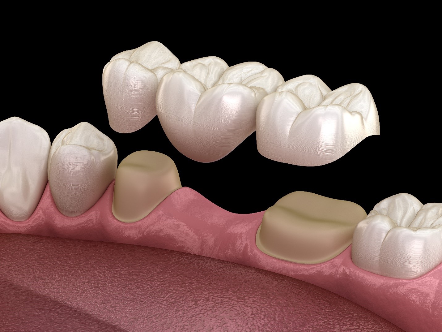 Dental bridges at My Scottsdale Dentist