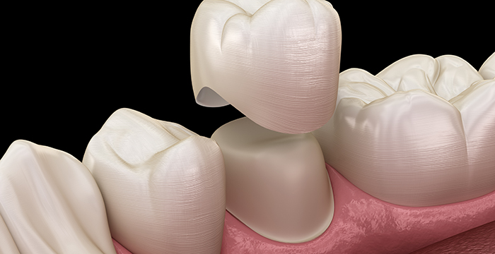 All-ceramic dental crowns