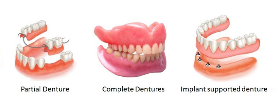 Full and partial dentures