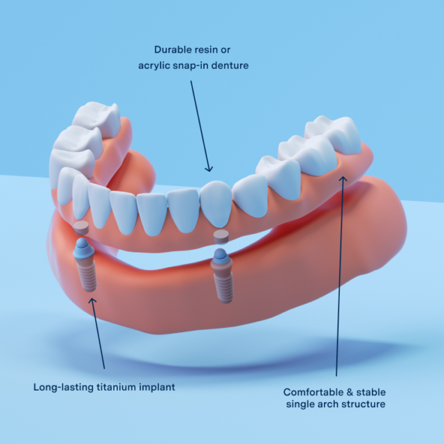 Snap-in implant denture showing titanium implant attachments