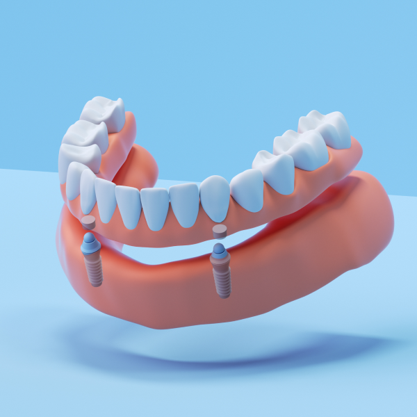 Snap-in implant dentures