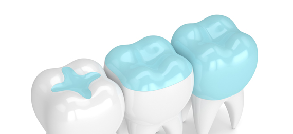 Porcelain inlays and onlays