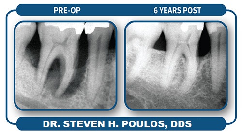 PerioLase MVP-7 laser used for LANAP treatment