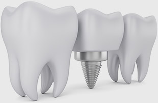 Dental implant showing peri-implantitis treatment area