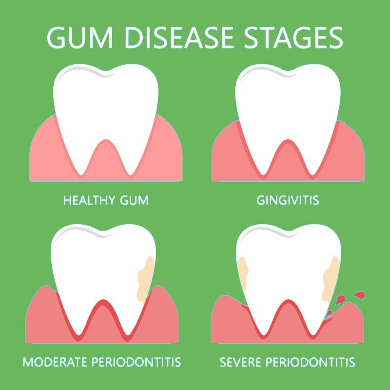 Periodontal treatment
