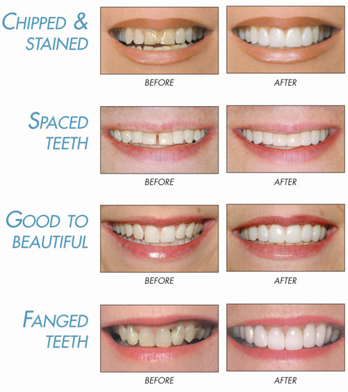 Porcelain veneers before and after