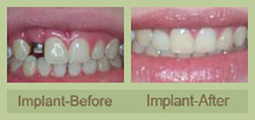 dental-implants-2