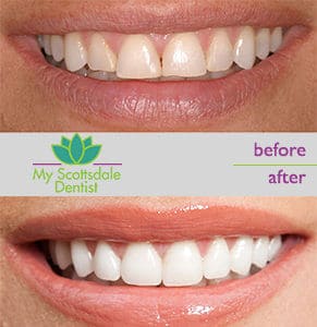 My Scottsdale Dentist Before and After
