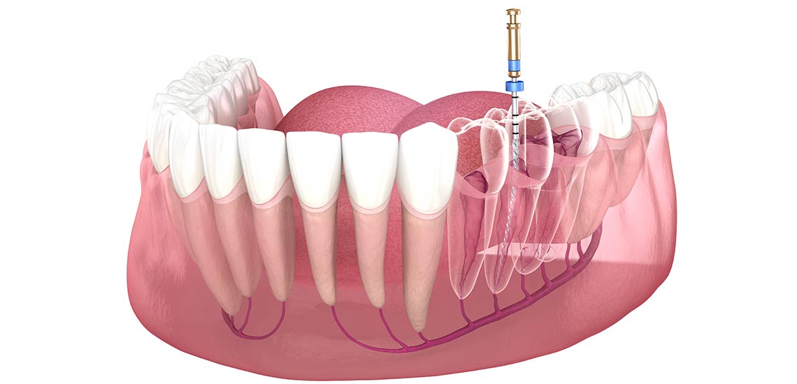 http://myscottsdaledentist.com/wp-content/uploads/2022/02/My-Scottsdale-Dentist-endodontics_.jpg