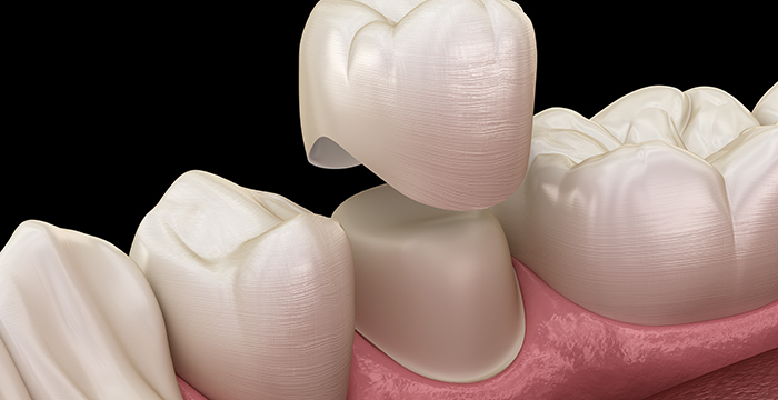 http://myscottsdaledentist.com/wp-content/uploads/2022/02/dental-crowns-Scottsdale-Dental.jpg