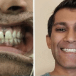 Overbite + Spacing