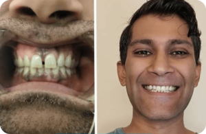 Overbite + Spacing